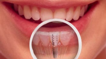 cost for invisalign fort worth tx